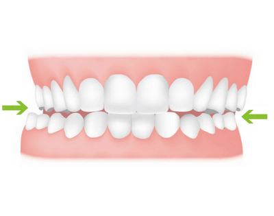 crossbite example crossbite example