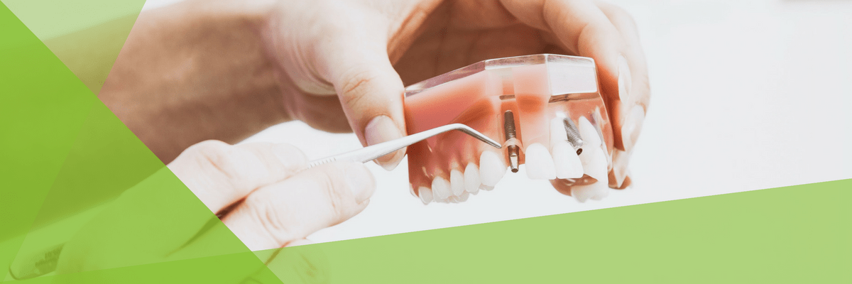 brush dental implants 1
