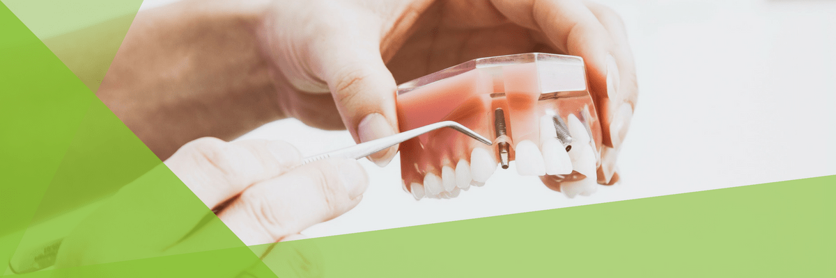 brush dental implants 1 brush dental implants 1